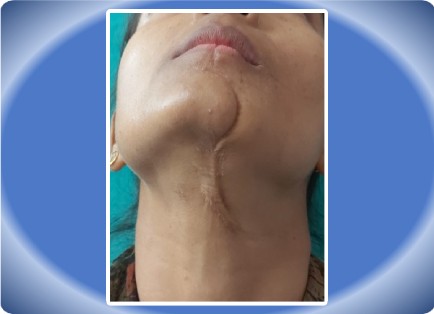 SCAR FACE